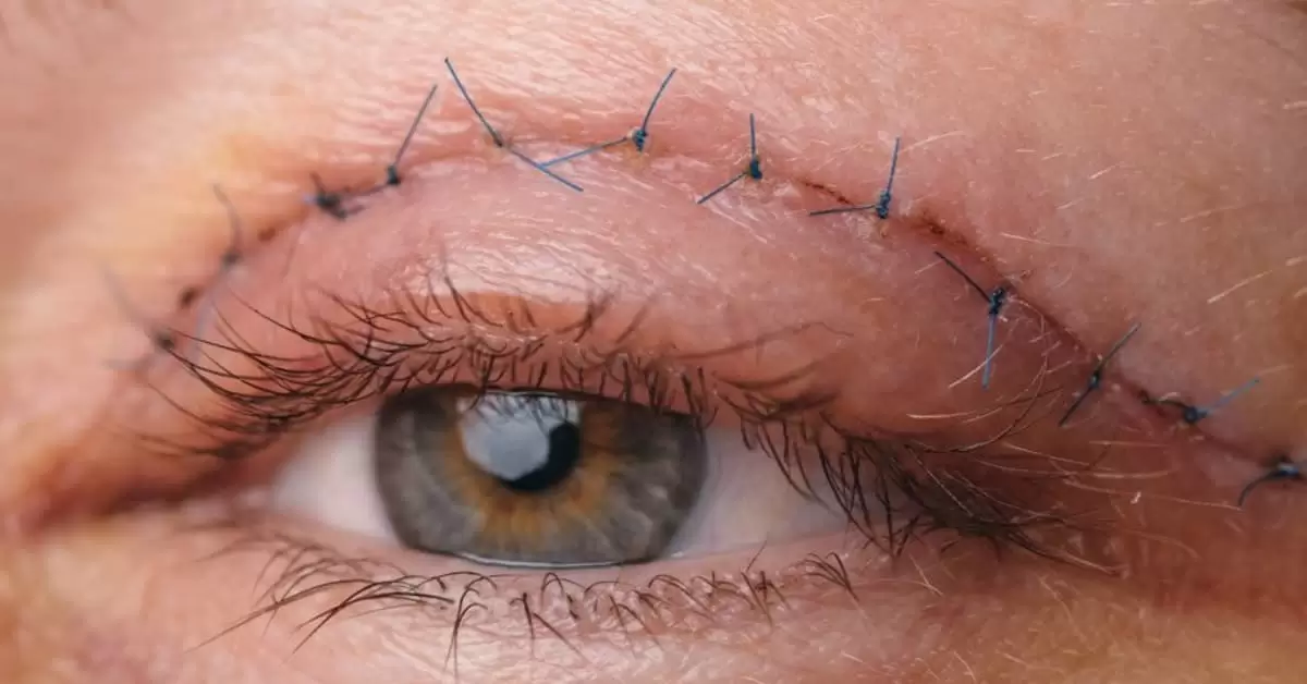 عوارض بلفاروپلاستی